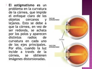  El astigmatismo es un
problema en la curvatura
de la córnea, que impide
el enfoque claro de los
objetos cercanos y
lejanos. Esto se debe a
que la córnea, en vez de
ser redonda, se achata
por los polos y aparecen
distintos radios de
curvatura en cada uno
de los ejes principales.
Por ello, cuando la luz
incide a través de la
córnea, se obtienen
imágenes distorsionadas.
 