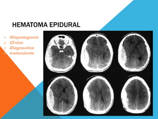 HEMATOMA EPIDURAL 
1. Etiopatogenia 
2. Clínica 
3. Diagnostico 
4. tratamiento 
 