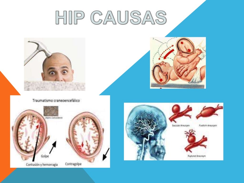 hematoma subdural, epidural, intraparenquimatoso hematoma subdural, epidural, intraparenquimatoso