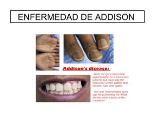 ENFERMEDAD DE ADDISON
 
