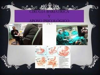 CIRUGÍA BARIÁTRICA
Y
APOYO PSICOLÓGICO
 