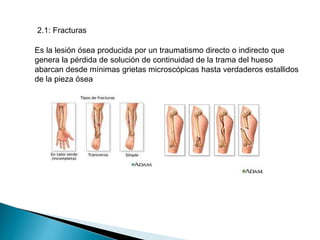 2.1: Fracturas
Es la lesión ósea producida por un traumatismo directo o indirecto que
genera la pérdida de solución de continuidad de la trama del hueso
abarcan desde mínimas grietas microscópicas hasta verdaderos estallidos
de la pieza ósea

 