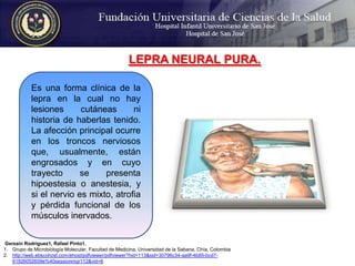 LEPRA NEURAL PURA.Es una forma clínica de la lepra en la cual no hay lesiones cutáneas ni historia de haberlas tenido. La afección principal ocurre en los troncos nerviosos que, usualmente, están engrosados y en cuyo trayecto se presenta hipoestesia o anestesia, y si el nervio es mixto, atrofia y pérdida funcional de los músculos inervados.Gerzaín Rodríguez1, Rafael Pinto1.Grupo de Microbiología Molecular, Facultad de Medicina, Universidad de la Sabana, Chía, Colombiahttp://web.ebscohost.com/ehost/pdfviewer/pdfviewer?hid=113&sid=30796c34-aa9f-4b85-bcd7-61926052609e%40sessionmgr112&vid=6