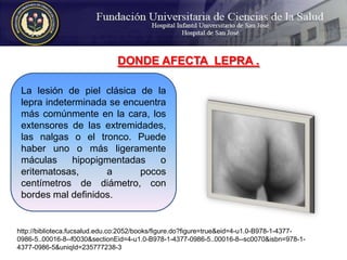 DONDE AFECTA  LEPRA . La lesión de piel clásica de la lepra indeterminada se encuentra más comúnmente en la cara, los extensores de las extremidades, las nalgas o el tronco. Puede haber uno o más ligeramente máculas hipopigmentadas o eritematosas, a pocos centímetros de diámetro, con bordes mal definidos. http://biblioteca.fucsalud.edu.co:2052/books/figure.do?figure=true&eid=4-u1.0-B978-1-4377-0986-5..00016-8--f0030&sectionEid=4-u1.0-B978-1-4377-0986-5..00016-8--sc0070&isbn=978-1-4377-0986-5&uniqId=235777238-3
