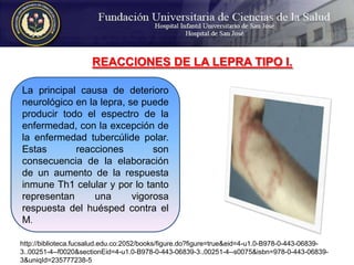REACCIONES DE LA LEPRA TIPO I. La principal causa de deterioro neurológico en la lepra, se puede producir todo el espectro de la enfermedad, con la excepción de la enfermedad tubercúlide polar. Estas reacciones son consecuencia de la elaboración de un aumento de la respuesta inmune Th1 celular y por lo tanto representan una vigorosa respuesta del huésped contra el M. http://biblioteca.fucsalud.edu.co:2052/books/figure.do?figure=true&eid=4-u1.0-B978-0-443-06839-3..00251-4--f0020&sectionEid=4-u1.0-B978-0-443-06839-3..00251-4--s0075&isbn=978-0-443-06839-3&uniqId=235777238-5