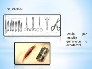 - POR DIERESIS:
lesión por
incisión
quirúrgica o
accidental.
 