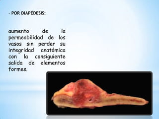 - POR DIAPÉDESIS:
aumento de la
permeabilidad de los
vasos sin perder su
integridad anatómica
con la consiguiente
salida de elementos
formes.
 