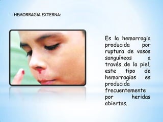 - HEMORRAGIA EXTERNA:
Es la hemorragia
producida por
ruptura de vasos
sanguíneos a
través de la piel,
este tipo de
hemorragias es
producida
frecuentemente
por heridas
abiertas.
 