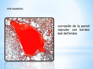 - POR DIABROSIS:
corrosión de la pared
vascular con bordes
mal definidos.
 