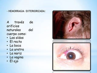 - HEMORRAGIA EXTERIORIZADA:
A través de
orificios
naturales del
cuerpo como:
• Los oídos
• El recto
• La boca
• La uretra
• La nariz
• La vagina
• El ojo
 