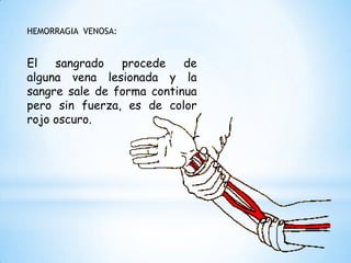 HEMORRAGIA VENOSA:
El sangrado procede de
alguna vena lesionada y la
sangre sale de forma continua
pero sin fuerza, es de color
rojo oscuro.
 