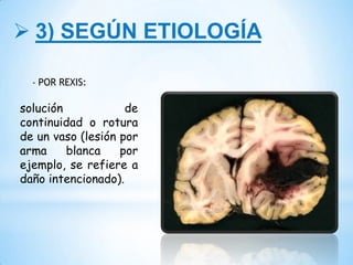  3) SEGÚN ETIOLOGÍA
- POR REXIS:
solución de
continuidad o rotura
de un vaso (lesión por
arma blanca por
ejemplo, se refiere a
daño intencionado).
 