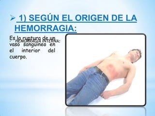  1) SEGÚN EL ORIGEN DE LA
HEMORRAGIA:
- HEMORRAGIA INTERNA:
Es la ruptura de un
vaso sanguíneo en
el interior del
cuerpo.
 