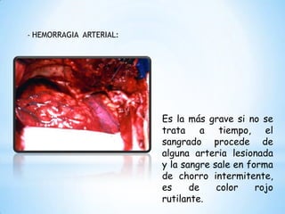 - HEMORRAGIA ARTERIAL:
Es la más grave si no se
trata a tiempo, el
sangrado procede de
alguna arteria lesionada
y la sangre sale en forma
de chorro intermitente,
es de color rojo
rutilante.
 