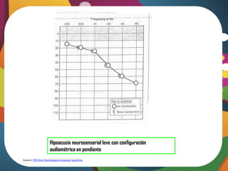 Hipoacusia neurosensorial leve con configuración
                                 audiométrica en pendiente
Tomado de: STACH, Brad. Clinical Audiology An Introduction. Second Edition
 