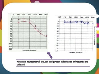 Hipoacusia neurosensorial leve, con configuración audiométrica en frecuencia alta
unilateral
 