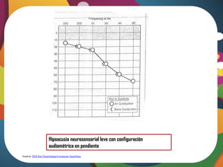 Hipoacusia neurosensorial leve con configuración
                                 audiométrica en pendiente
Tomado de: STACH, Brad. Clinical Audiology An Introduction. Second Edition
 