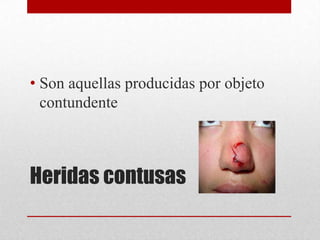 • Son aquellas producidas por objeto
  contundente



Heridas contusas
 