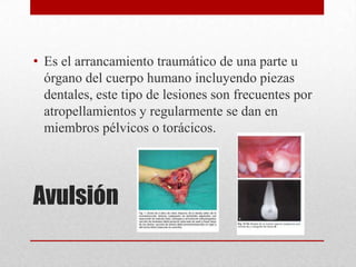 • Es el arrancamiento traumático de una parte u
  órgano del cuerpo humano incluyendo piezas
  dentales, este tipo de lesiones son frecuentes por
  atropellamientos y regularmente se dan en
  miembros pélvicos o torácicos.




Avulsión
 