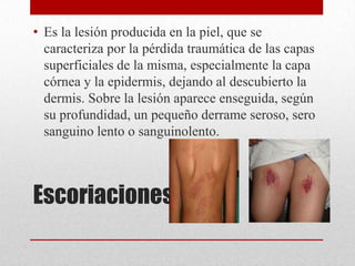 • Es la lesión producida en la piel, que se
  caracteriza por la pérdida traumática de las capas
  superficiales de la misma, especialmente la capa
  córnea y la epidermis, dejando al descubierto la
  dermis. Sobre la lesión aparece enseguida, según
  su profundidad, un pequeño derrame seroso, sero
  sanguino lento o sanguinolento.



Escoriaciones
 
