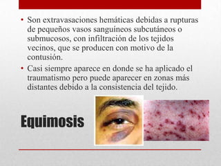 • Son extravasaciones hemáticas debidas a rupturas
  de pequeños vasos sanguíneos subcutáneos o
  submucosos, con infiltración de los tejidos
  vecinos, que se producen con motivo de la
  contusión.
• Casi siempre aparece en donde se ha aplicado el
  traumatismo pero puede aparecer en zonas más
  distantes debido a la consistencia del tejido.



Equimosis
 