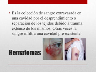 • Es la colección de sangre extravasada en
  una cavidad por el desprendimiento o
  separación de los tejidos debido a trauma
  extenso de los mismos. Otras veces la
  sangre infiltra una cavidad pre-existente.



Hematomas
 