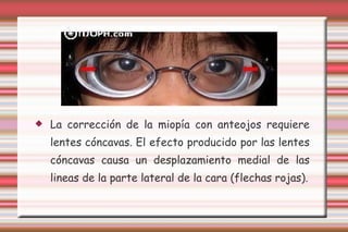 La corrección de la miopía con anteojos requiere lentes cóncavas. El efecto producido por las lentes cóncavas causa un desplazamiento medial de las lineas de la parte lateral de la cara (flechas rojas). 