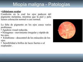 Miopía maligna - Patologías <ul><li>Albinismo ocular </li></ul><ul><li>Condición en la cual los ojos padecen del pigmento ...