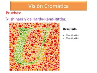 Hardy Randy Rittler Semiologia del Nervio óptico | PPTX