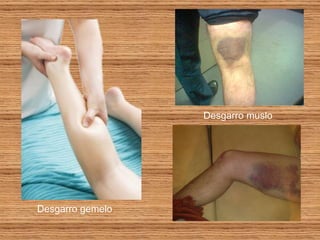 Desgarro muslo Desgarro gemelo 
