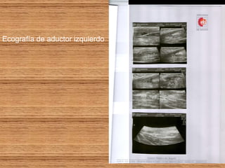 Ecografía de aductor izquierdo 