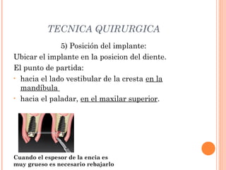 TECNICA QUIRURGICA
5) Posición del implante:
Ubicar el implante en la posicion del diente.
El punto de partida:
• hacia el lado vestibular de la cresta en la
mandíbula
• hacia el paladar, en el maxilar superior.
Cuando el espesor de la encia es
muy grueso es necesario rebajarlo
 