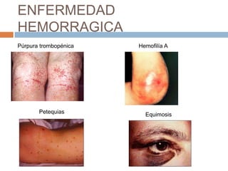 ENFERMEDAD
HEMORRAGICA
Púrpura trombopénica   Hemofilía A




       Petequias         Equimosis
 