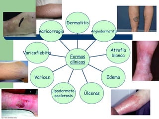 Dermatitis
       Varicorragia                Angiodermatitis




                                              Atrofia
Va...