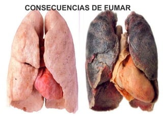 CONSECUENCIAS DE FUMAR 