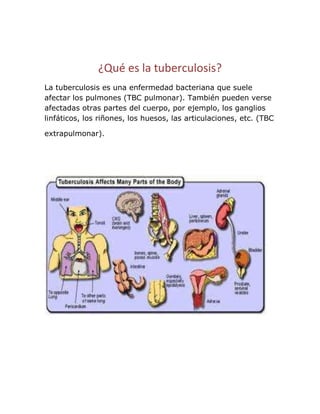 ¿Qué es la tuberculosis?
La tuberculosis es una enfermedad bacteriana que suele
afectar los pulmones (TBC pulmonar). También pueden verse
afectadas otras partes del cuerpo, por ejemplo, los ganglios
linfáticos, los riñones, los huesos, las articulaciones, etc. (TBC

extrapulmonar).
 