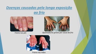 Doenças causadas pela longa exposição
ao frio
Frieira nos pés Queimaduras graves por causa do frio
Frieira nas mãos
 
