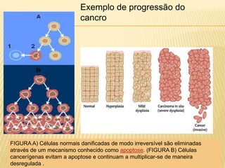 Exemplo de progressão do
cancro

FIGURA A) Células normais danificadas de modo irreversível são eliminadas
através de um mecanismo conhecido como apoptose. (FIGURA B) Células
cancerígenas evitam a apoptose e continuam a multiplicar-se de maneira
desregulada .

 