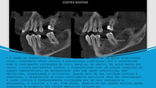 • A lesão se desenvolve na superfície lateral da raiz de um dente erupcionado
vital, usualmente entre caninos e pré-molares inferiores. Ele é considerado
como a contraparte intraóssea do cisto gengival do adulto. Na maior parte dos
casos, o cisto periodontal lateral é diagnosticado como um achado ocasional em
exames radiográficos, se apresentando como uma lesão radiolúcida, bem
delimitada, arredondada e unilocular. Quando mais de uma cavidade cística é
observada, o diagnóstico de cisto odontogênico botrioide deve ser considerado.
A lesão cística é frequentemente circundada por um halo radiopaco e,
geralmente, é inferior a 1 cm. Além disso, observa-se que lesões maiores podem
ocasionar divergência das raízes dentárias adjacentes.
 