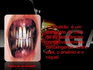 • O alcatrão é um
composto de mais
de 40 substâncias
comprovadamente
cancerígenas. Entre
elas, o arsênio e o
níquel.
Dentes de um fumante
 
