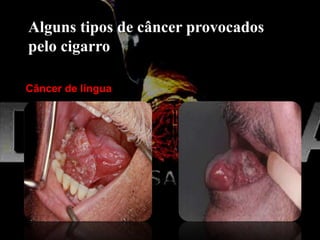 Alguns tipos de câncer provocados
pelo cigarro
Câncer de língua
 