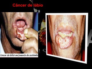 Câncer de lábio
 