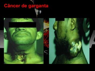 Câncer de garganta
 
