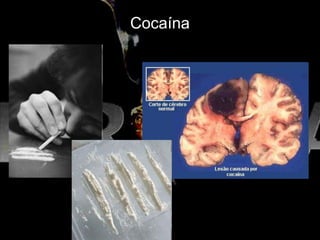 Cocaína
 