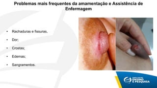 Problemas mais frequentes da amamentação e Assistência de
Enfermagem
• Rachaduras e fissuras,
• Dor;
• Crostas;
• Edemas;
• Sangramentos.
 