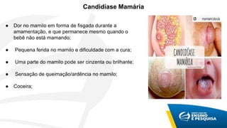 Candidíase Mamária
● Dor no mamilo em forma de fisgada durante a
amamentação, e que permanece mesmo quando o
bebê não está mamando;
● Pequena ferida no mamilo e dificuldade com a cura;
● Uma parte do mamilo pode ser cinzenta ou brilhante;
● Sensação de queimação/ardência no mamilo;
● Coceira;
 