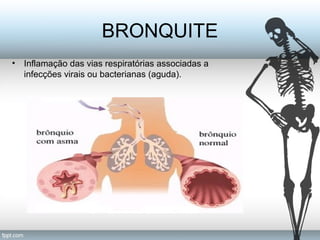 BRONQUITE 
• Inflamação das vias respiratórias associadas a 
infecções virais ou bacterianas (aguda). 
 