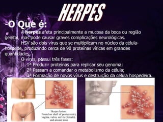 O Que é: A  herpes  afeta principalmente a mucosa da boca ou região genital, mas pode causar graves complicações neurológicas.  HSV são dois vírus que se multiplicam no núcleo da célula-hóspede, produzindo cerca de 90 proteínas víricas em grandes quantidades.  O vírus, possui três fases:   1ª Produzir proteínas para replicar seu genoma;   2ª Passam a comandar o metabolismo da célula;   3ª Formação de novos vírus e destruição da célula hospedeira. HERPES 