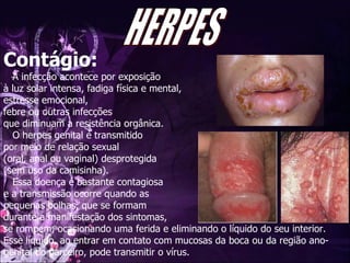 Contágio: A infecção acontece por exposição  à luz solar intensa, fadiga física e mental,  estresse emocional,  febre ou outras infecções  que diminuam a resistência orgânica.   O herpes genital é transmitido  por meio de relação sexual  (oral, anal ou vaginal) desprotegida  (sem uso da camisinha).  Essa doença é bastante contagiosa e a transmissão ocorre quando as  pequenas bolhas, que se formam durante a manifestação dos sintomas,  se rompem, ocasionando uma ferida e eliminando o líquido do seu interior.  Esse líquido, ao entrar em contato com mucosas da boca ou da região ano-genital do parceiro, pode transmitir o vírus.  HERPES 