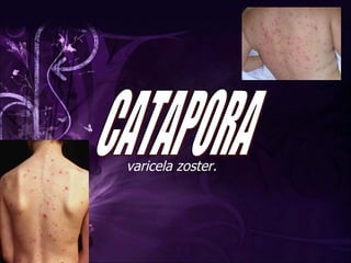 varicela zoster. CATAPORA 